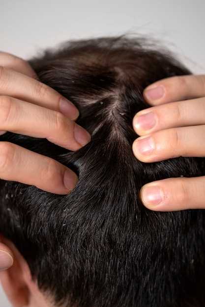 Hair loss levothyroxine