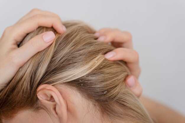 Hairloss and levothyroxine